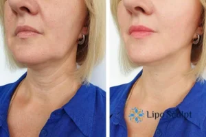Double chin before and after Hi-Fu treatment 4 Book your double chin treatment Wakefield today! We are here to help!