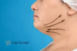 Double chin before and after Hi-Fu treatment 3 Boost your confidence with a Double chin treatment Wakefield
