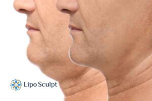 Double chin before and after Hi-Fu treatment 2 Double chin treatment Wakefield from Lipo Sculpt - feel more confident today!