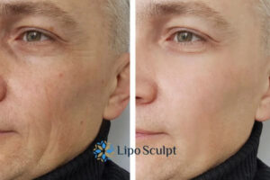 How to Fight Aging Symptoms 3 Fight Aging Symptoms Wakefield With HIFU and Morpheus8 Today!