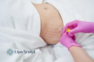 Are The Results From Aqualyx Permanent? 1 Do you want to know how long Aqualyx Wakefield results last?