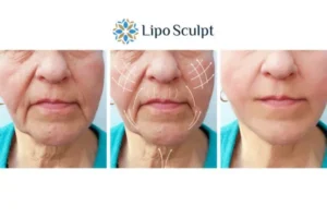 Explaining Morpheus8 And What It Can Do For You 3 Boost your confidence with Morpheus8 Wakefield call our team today!
