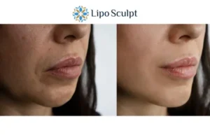 Explaining Morpheus8 And What It Can Do For You 4 Morpheus8 Wakefield the best results - call our team today!