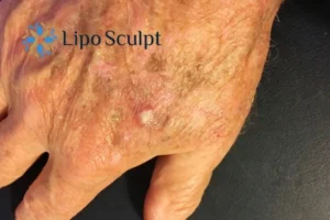 Best Actinic Keratoses Removal 2 Improve your wellbeing and health with Actinic Keratoses Wakefield removal.treatment