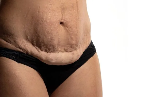 Lost the Weight but Not the Loose Skin? 1 image of womans stomach after weight loss showing loose skin Wakefield